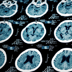 New treatment for wide-necked brain aneurysm Main Image