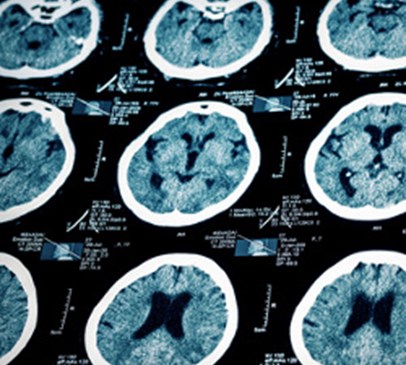 New treatment for wide-necked brain aneurysm Main Image