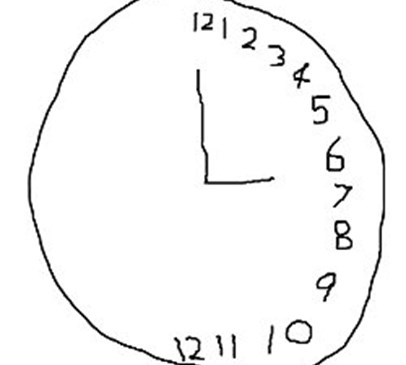 Repetitive transcranial magnetic stimulation (rTMS) Main Image