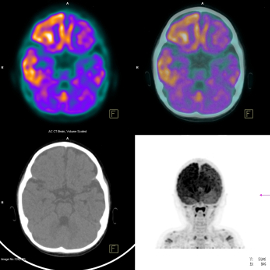 Functional brain imaging may predict potential for recovery, says new research Main Image