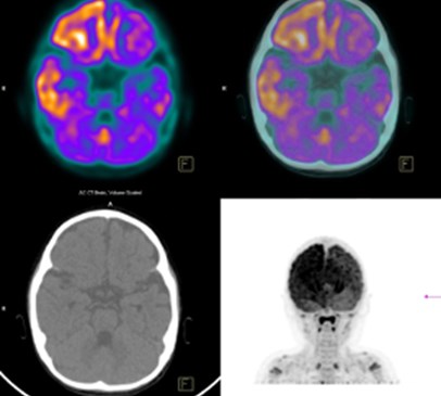 Functional brain imaging may predict potential for recovery, says new research Main Image