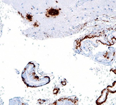 Head injury patients develop brain clumps associated with Alzheimer’s disease Main Image