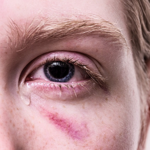 Domestic Abuse Bill debate highlights extent of brain injury among victims of domestic violence Main Image