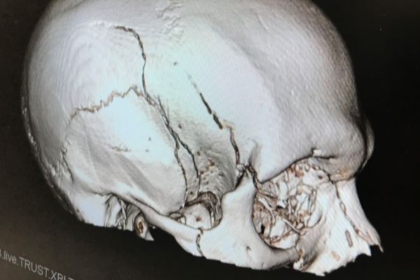 Ross' skull was fractured in multiple places